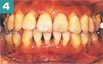 4.重度歯周病